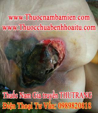 Chữa Khỏi Hoại Tử Mông - Bệnh nhân ở Thanh Hoá